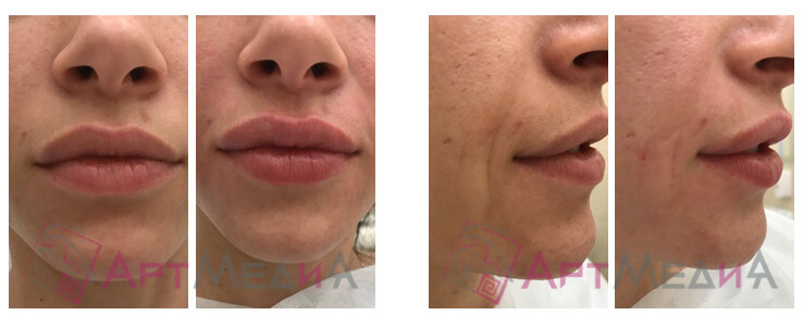 Фото до и после пластики половых губ