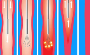 Эндовазальная лазерная коагуляция вен